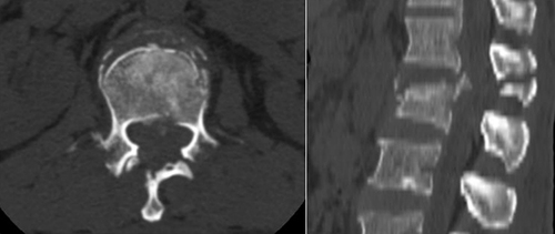 Figure 5 Axial and sagittal CT images: Subtype B2 injury. This is a CT image of L2 vertebrae injury of a 51-year-old female patient. She had a heavy object fall on her back.