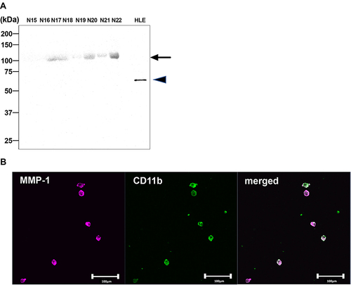 Figure 4 Induction of MMP-1 expression in peripheral blood monocytic lineage cells after co-culture with steatosis hepatocytes. (A) Protein blot analysis showing no detectable MMP-1 in plasma exosomes from 8 patients with NASH (N). HLE cell lysates were used as a positive control for MMP-1 expression. The arrow indicates non-specific broad bands with different sizes from that observed with HLE cell lysates (arrowhead). (B) After 7-day co-culture with steatotic hepatocytes, peripheral blood monocytic progenitor cells (R3) obtained from an advanced-stage NASH patient were subjected to double immunofluorescent staining using anti-CD11b and anti-MMP-1 antibodies. Scale bar, 100 μm.