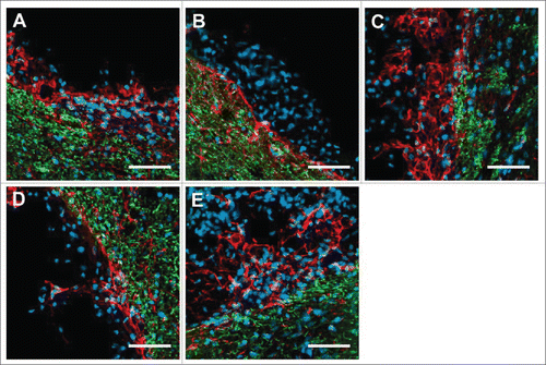 Figure 5. Images of the neurite network at the tissue-implant interface. Astrocytes (GFAP, Red), neurofilament (RT97, green), and nuclei (DAPI, blue) were stained to determine if neurite extension into the hybrid scaffold occurred. The samples were as follows: (A) Blank hydrogel, (B) PLLA fibers – low density, (C) PLLA + fibronectin fibers – low density, (D) PLLA fibers – high density, and (E) PLLA + fibronectin – high density. The fibronectin fiber samples, C and E, display a greater extent of astrocyte infiltration into hybrid matrix as well as a more loosely defined glial boundary as compared to that displayed in B; however, in all cases there were no neurites protruding and into the hybrid scaffold and interacting with the electrospun fiber network. Images were captured with a 40X objective lens. Z-stack ranges were optimized for each fluorescence channel and captured independently. Scale bar represents 50 μm.