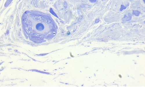 Figure 1 Micrograph showing a transverse section of tendon obtained from a temporal rectus muscle, displaying an small artery enveloped by collagen and fibrocytes. No evidence of muscle fibres. Section stained with Toluidine blue.