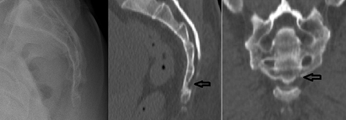 Figure 4 This 46-year-old man fell from a height, neurologically intact. A lateral radiograph did not show any significant injury. Sagittal and coronal CT scan images show sacral fracture subtype A2 (arrows).