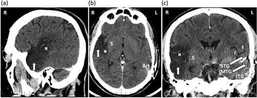 Figure 1. Sagittal (panel a), axial (panel b) and coronal (panel c) CT (computed tomography) scans performed 2 months after the infarct. They demonstrate the right temporal & inferior frontal lobe infarct (dark region as directed by vertical arrows). The right superior temporal gyrus (STG), the right middle temporal gyrus (MTG) and the right insula were damaged by the stroke, but the right inferior temporal gyrus (ITG) was relatively spared. The infarct involves the right transverse temporal gyrus of heschl (×), which is the primary auditory cortex. The right striatum (S) is also shown, medial to the infarct. The left STG, left MTG, left ITG, left insular cortex (I), and left frontal lobe (F) are shown. The white region within the left STG is caused by the artifact from the left cochlear implant. A similar artifact (art) is also seen in the axial image (panel b).