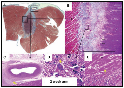 Figure 5 Epicardial ventricular ablation over a coronary artery.