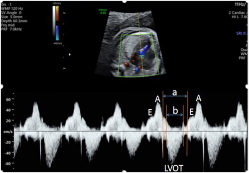 Figure 3. Schematic diagram of calculating Tei index. The time (a) between the end of mitral A wave to the beginning of E wave in the next cardiac cycle, and the duration (b) of aortic ejection were measured after the Doppler spectra of LV inflow and outflowtract were obtained. Tei index = (a–b)/b. LVOT: Left ventricular outflow tract. 