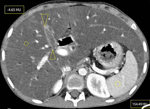 Figure 3 Axial CECT at the level of the gallbladder (between open arrow heads) showing micro-gallbladder (here, measuring 3.79 cm long and 1.3 cm wide), hepatomegaly and hepatic steatosis (elliptical areas showing hepatic and splenic attenuation of −4.65 HU and 154.49 HU, respectively). The vascular markings also stand out against the background hepatic parenchyma, demonstrating more evidence of hepatic steatosis . Measurement of hepatic and splenic attenuation at NCECT and CECT at multiple sections showed a range of −14 to −33 HU on NCECT and −2.5 to 22.5 HU on CECT for liver; which was in comparison to the mean splenic attenuations of 45.5–53.5 and 141.61–154.49 HU at NCECT and CECT, respectively. Please also note beaver’s tail, a normal anatomic variant unrelated to CF, where the liver parenchyma of the left hepatic lobe wraps around the spleen. Riedel's lobe, a normal variant of liver parenchymal extension beyond the lower margin of the kidney, was also seen but is not demonstrated here.