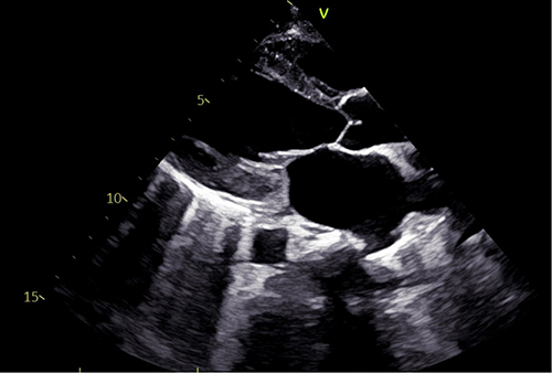 Figure 1 Cardiac ultrasound at admission (left ventricular long axis section).