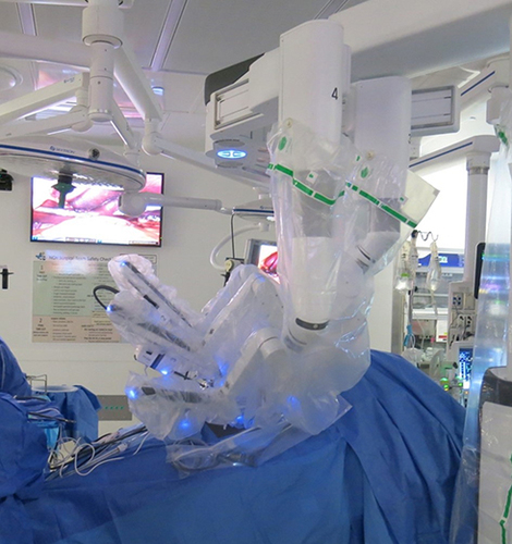 Figure 3 Intraoperative photograph with the robotic surgery system docked at the operating room table which is in reverse Trendelenburg position to facilitate surgical visualization of the abdominal contents. The patient’s head is to the right.