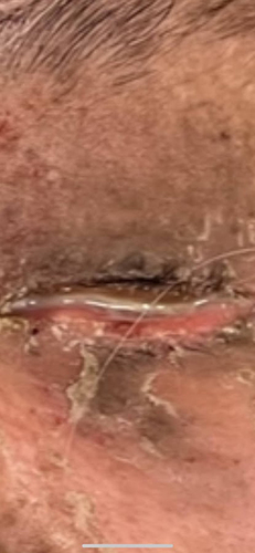Figure 3 Sloughed mucosa on the lashes and around the eyelids with drainage.