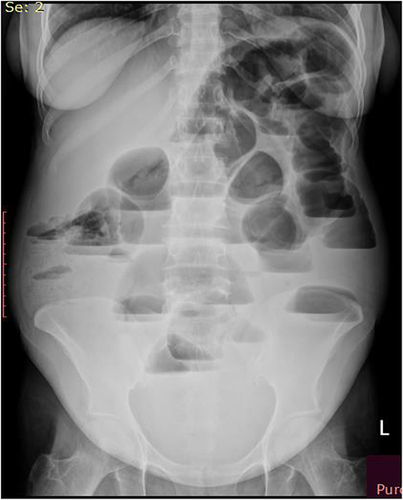 Figure 1 On plain abdominal x-ray- there is multiple air fluid level, dilated small bowel, valvulae conniventes are visible and absence of gas in the distal-collapsed bowel.