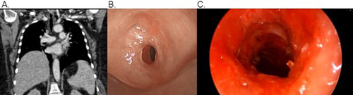Figure 3 Grade 3, concentric, corkscrew-type stenosis which extended at least 2 tracheal rings seen on CT chest (A) and pre-dilation bronchoscopy (B). Post-dilation bronchoscopy reveals airway patency (C).