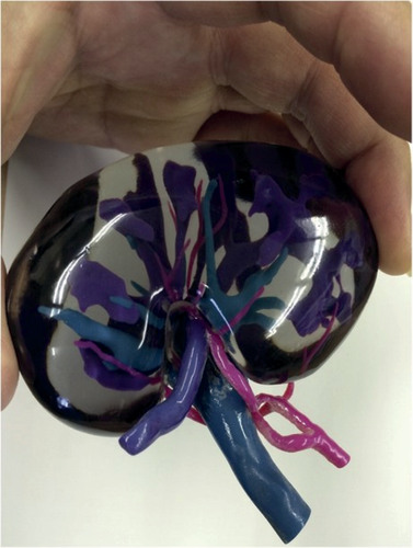 Figure 2. 3D printing in urology.The 3D printed donor organ kidney replicas.Reproduced with permission from [Citation41] © Elsevier (2015).