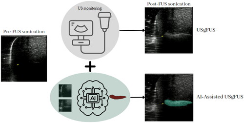 Figure 1. A comparative Illustration of conventional USgFUS technology and the proposed AI-assisted USgFUS for precise monitoring of FUS treatment. The traditional approach relies on grayscale variations in ultrasound B-mode images to visualize the ablated area, while our novel method employs AI-assisted labeling and real-time highlighting for quantitative and accurate assessment of FUS treatment progress.