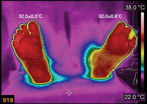 Figure 3. A thermogram of a diabetic female patient, who has a history of recurrent ulcers on her left foot. The average temperatures are written above each foot. The patient is 62 years old, BMI of 25.4 kg/m2, 15 years with diabetes diagnosis.