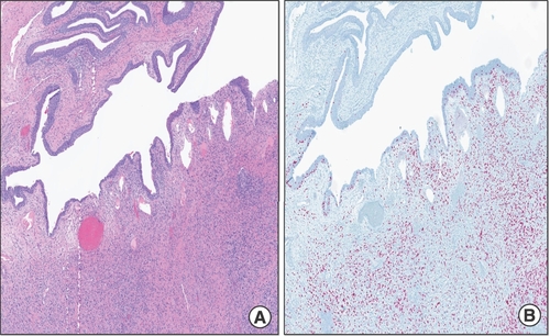 Figure 7. Radical cystourethrectomy showing pagetoid spread to the distal urethral margin. (A & B) Radical cystourethrectomy showing atypical melanoma cells of the urinary bladder with pagetoid spread of melanoma to the distal urethral margin.5× (left), tumor cells demonstrate positivity for SOX10 (right).