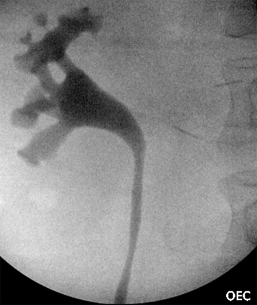 Figure 7 A right sided retrograde pyelogram showing mild hydroureter and hydronephrosis.