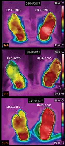 Figure 2. Three thermograms of the plantar skin of a diabetic patient, with the left Charcot foot. The date of the acquisition of the thermogram is at the the top of each thermogram. The average temperatures are written above each foot. This patient is a male, 62 years old, 27 years with diagnosis of diabetes mellitus.
