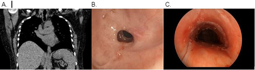 Figure 2 Grade 3, complex corkscrew-type stenosis which extended 3 tracheal rings seen on CT chest (A) and pre-dilation bronchoscopy (B). Post-dilation bronchoscopy reveals airway patency (C).