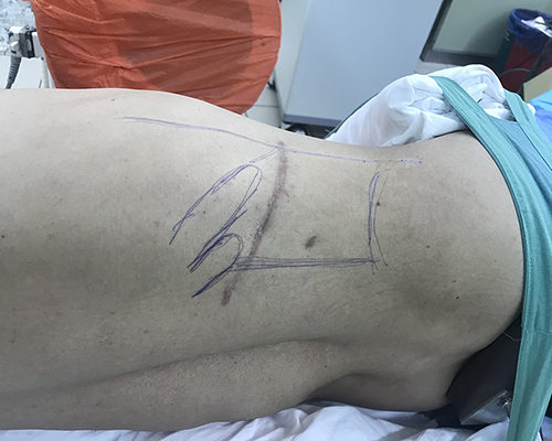 Figure 2 The patient was in lateral position.