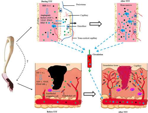 Figure 11 Schematic of the potential mechanism of DFU treatment using TTT. In response to transverse distraction, osteogenic activity (differentiation of bone marrow mesenchymal stem cells into osteoblasts) is elevated, leading to a localized hypoxic microenvironment. This triggers the expression of HIF-1α which in turn induces formation of multiple angiogenic factors such as VEGF, PDGF-BB, and SDF-1. These downstream factors promote angiogenesis and neovascularization to supply oxygen, nutrients, and critical signals for the newly formed bone and also carry away the metabolic wastes. Simultaneously, HIF-1α, VEGF, PDGF-BB, and SDF-1 travel through the trans-cortical capillaries into peripheral circulation and eventually reach the site of DFU, which is in hypoxic status and with low levels of HIF-1α, VEGF, PDGF-BB, and SDF-1. Similar to their effect in the bone transport site, these factors induce angiogenesis (differentiation of endothelial progenitor cells into endothelial cells) and neovascularization at the wound and improves the hypoxic status, ultimately resulting in ulcer healing.