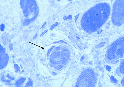 Figure 3 Micrograph showing a transverse section of human extraocular muscles displaying the preterminal distal end of a small dark staining muscle fibre where contractile elements are encapsulated by a few surrounding sheets of connective tissue (arrow). Section stained with Toluidine blue.