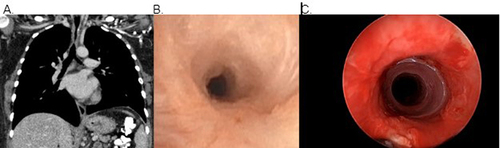 Figure 4 Grade 3, complex, concentric stenosis seen on CT chest (A) and pre-dilation bronchoscopy (B). Post-procedure bronchoscopy reveals airway patency with silicone studded hourglass stent in place (C).