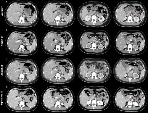 Figure 1 Contrast-enhanced CT images performed on August 7 (A), August 14 (B), August 22 (C), and September 26 (D) showing change of isolated splenic vein thrombosis (red arrow).