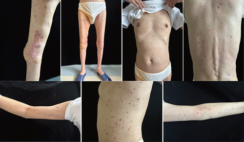 Figure 1 The patient develops a blister-like rash all over the body with widespread itching.