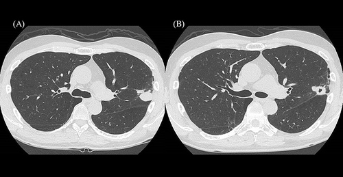Figure 1 Computed tomography scan results of our patient at the initial visit. (A) A 20 mm-sized nodule is present in the upper lobe of the left lung. (B) An 8 mm-sized cavity can be noted within the nodule during the course of the disease.