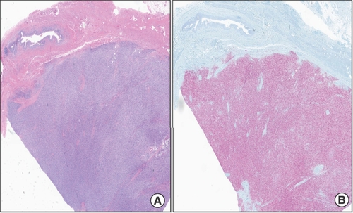 Figure 9. Radical cystourethrectomy showing atypical melanoma cells. (A & B) Radical cystourethrectomy showing atypical melanoma cells in the urinary bladder diffusely involving the submucosa and muscularis propria with corresponding urothelium uninvolved 1× (left), tumor cells demonstrate positivity for SOX10 (right).