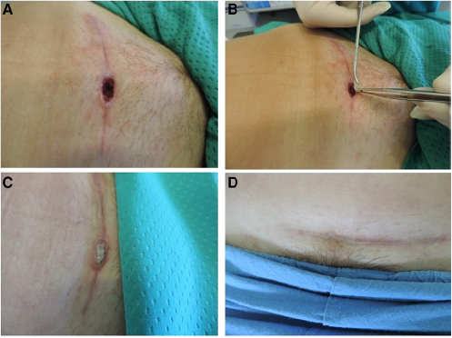 Figure 14 Application of lyophilized acellular gamma-irradiated dermis (DED LIO) over a dehisced surgical wound (gastric-onchologic surgery). (A,B,C) Complete healing assessed after 30 days; (D) with integration of DED LIO into the wound bed