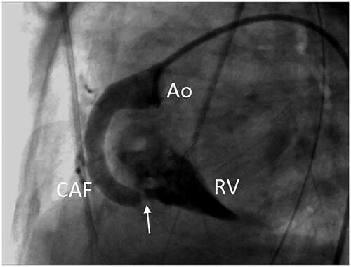 Figure 2. Selective right coronary artery angiography showing dilation of the fistulous tract with a distal narrowing (arrow) prior to its drainage into the right ventricle (RV). Ao: aorta; CAF: coronary artery fistula.