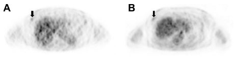 Figure 5 Dual time point FDG-PET images of a 60 year-old female patient.