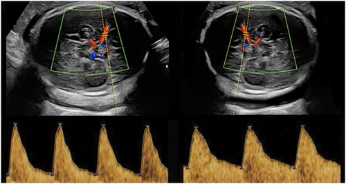 Figure 2. Shown in the image on the left is a PI of 1.74 at 34 weeks of gestation (normal finding). The fetus on the right has a decreased MCA PI (1.23) at the same gestational age.