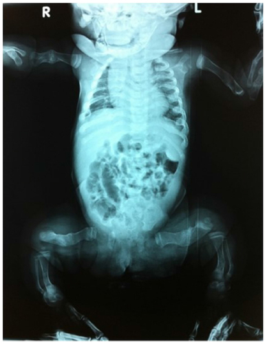 Figure 2 OI type III, 2-month-old baby girl.